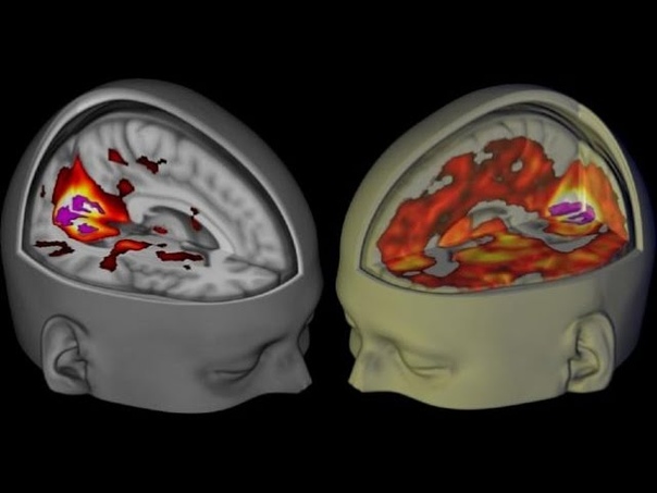 LSD Brain Scan Reveals Stunning