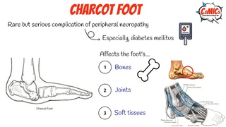 CoMICs Episode 63: Charcot foot