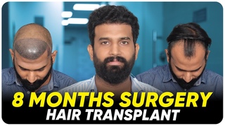 Hair Transplant in Ballari | Best Results & Cost of Hair Transplant in Ballari